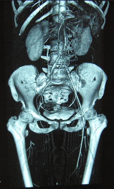 Thromboangiitis obliterans